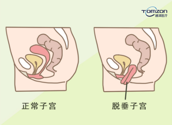 你害怕子宮脫垂嗎？盆底肌修復(fù)儀器來拯救你