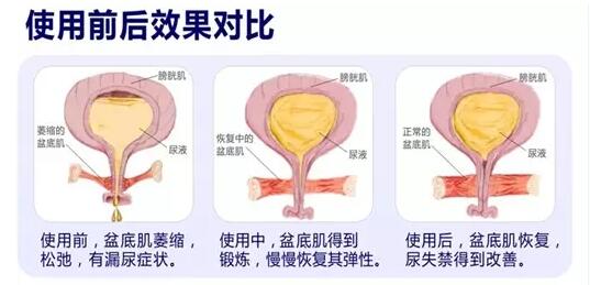 產(chǎn)后盆底肌怎么修復(fù)