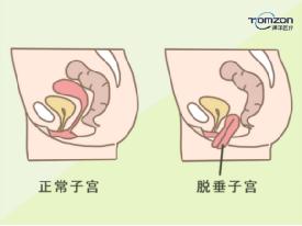 盆底肌修復(fù)儀器