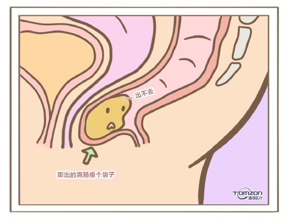 盆底肌修復(fù)儀器